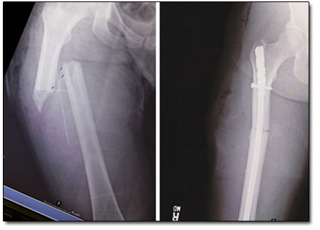 Before and after x-rays of Kristin's femur; the latter showing
the titanium rod bolted to the bone.